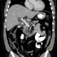 Choledocholithiasis, gallstones: CT - Computed tomography